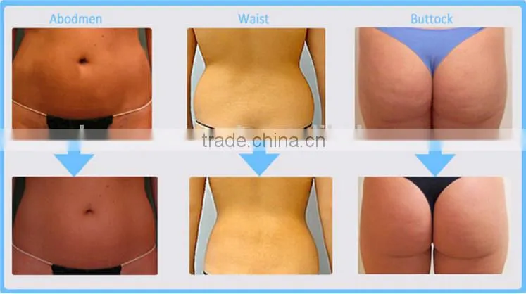 HIFU ultrasound technology resolve fat sells with training video