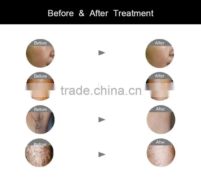 Big power/Big spot size/10 bars/ professional portable 808nm Diode Laser hair removal machines