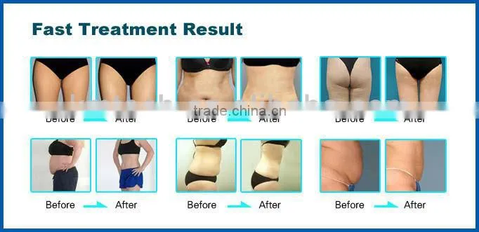 elight laser with bipolar ice RF