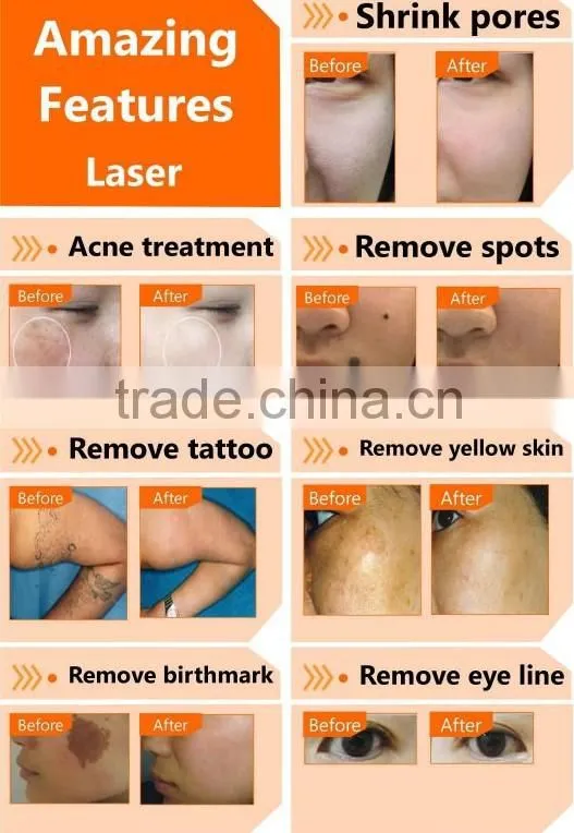 salon use professional laser tattoo removal machine in big sale