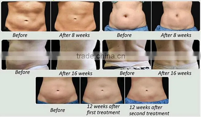 Criolipolise for cosmetology body fat removal