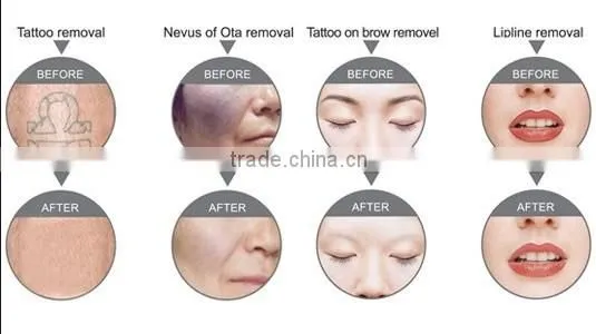 Professtional q-switched 10 hz nd yag laser for tattoo removal