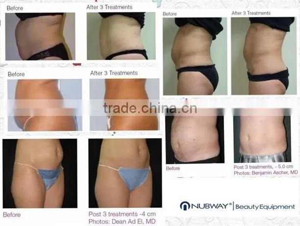 New fat reduction equipment hifu liposonix fat reduce machine