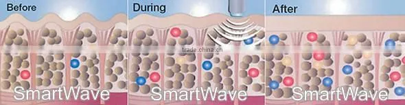 Acoustic shockwave for cellulite and body reshaper orange peel treatment