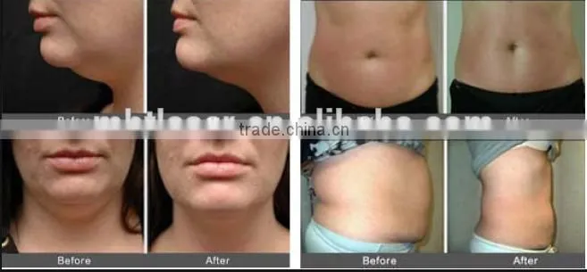 2016 Vacuum Cavitation RF System Body Slimming machine