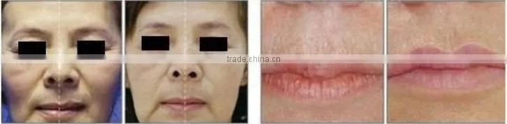 Best RF CO2 fractional laser skin treatment machine for chloasmas and pigmentation removal OY-11