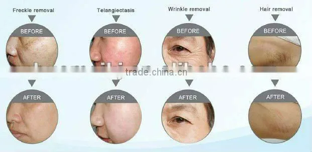 promotion!!! lowest price Cosmetic professional ipl laser facial rejuvenation machine