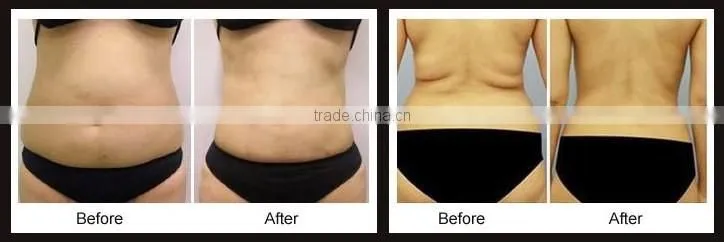 FU-13 HIFU body slimming machine Lipo HIFU Slimming with 8.0mm 13.0mm treatment heads