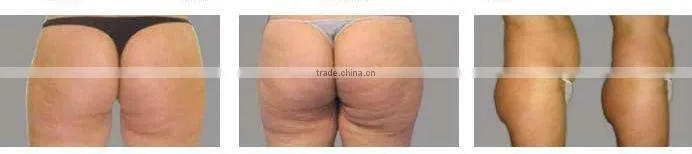 Multipolar RF Vaccum Cavitation Liposuction Slimming MachineF019
