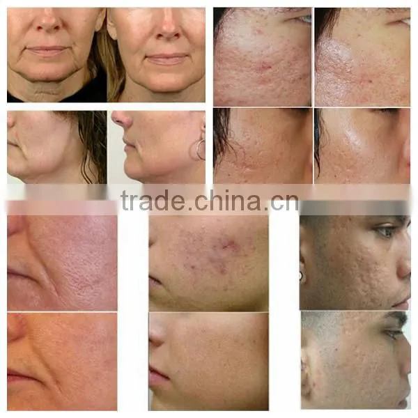 Best salon beauty equipment! RF Fractional Micro needle wrinkle removal facial massage machine/Microneedle fractional rf