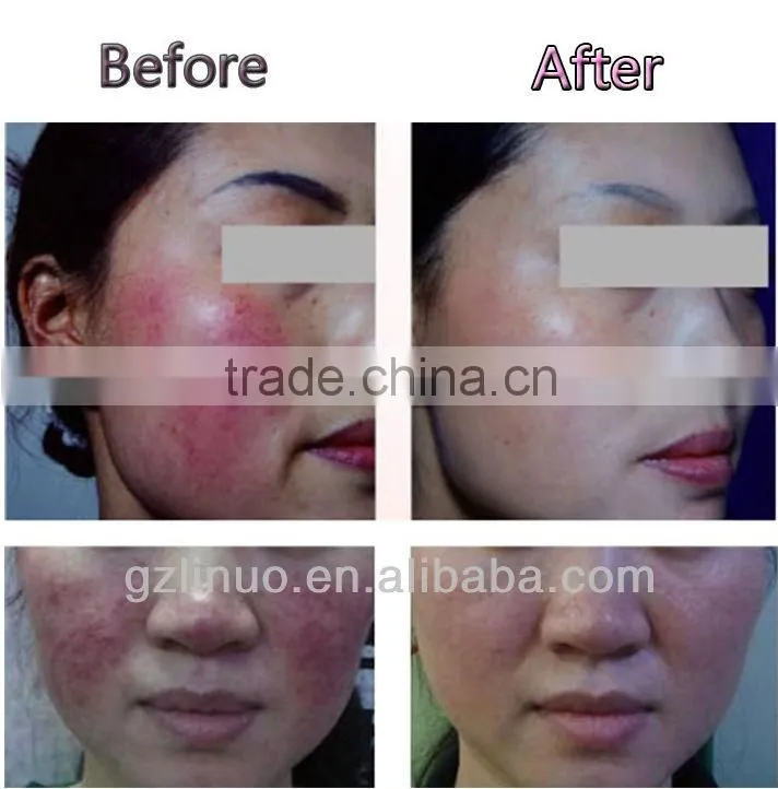 Excellent portable red vascular laser treatment
