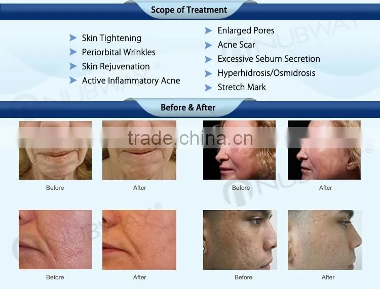 2016 fractional rf needle/Fractional RF micro-needle mesotherapy