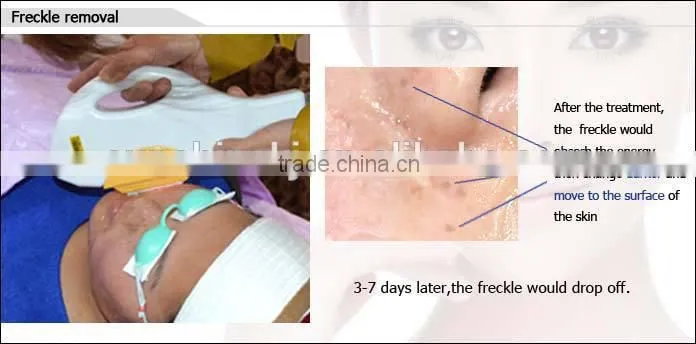 IPL Hair Removal Skin Rejuvenation Vascular&Acne Removal Beauty Salon Equipment&Machine