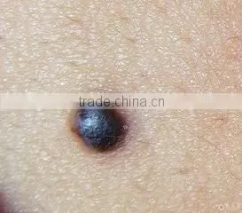 Micro Portable Handhold freckles removal pen