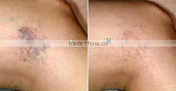 Perfect nd yag laser professional remove hair safe to dark skin