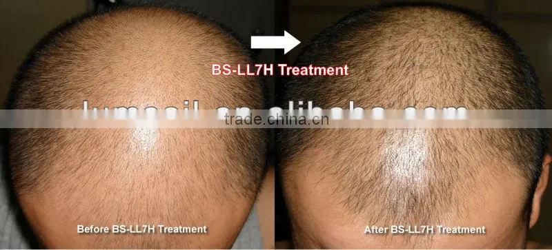 Professional Diode laser hair regrowth treatment
