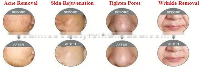 hot sale Factory direct SC-2 laser tube co2/acne removal laser tube co2/co2 vaginal rejuvenation