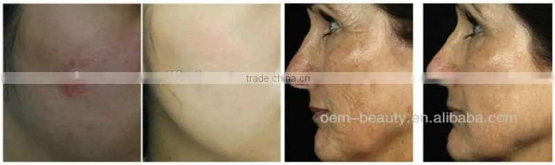 Laser epilator 2016 equipment for sale P001