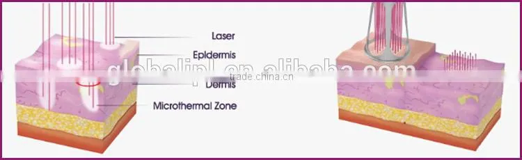 age spots removal clinic use skin renew erbuim laser skin resurfacing machine