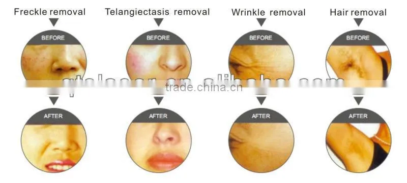 (Hot in United States)powerful multifuctional machine 2 in 1 elight rf laser equipment