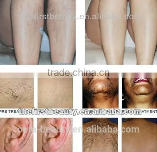 depilation diode laser hair removal 808 hair removal device for bikini diode laser
