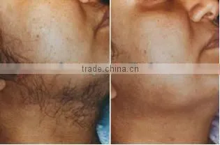 2016 hottest laser hair removal machine 1064nm Laser Hair Removal machine P001
