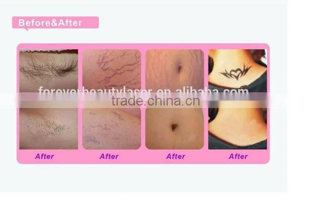 NEW YEAR PROMOTION Nd Yag Laser IPL Skin Rejuvenation/laser ipl hair removal /tattoo removal equipmentL
