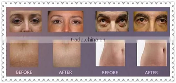 Allfond instant effect wrinkle remover machine