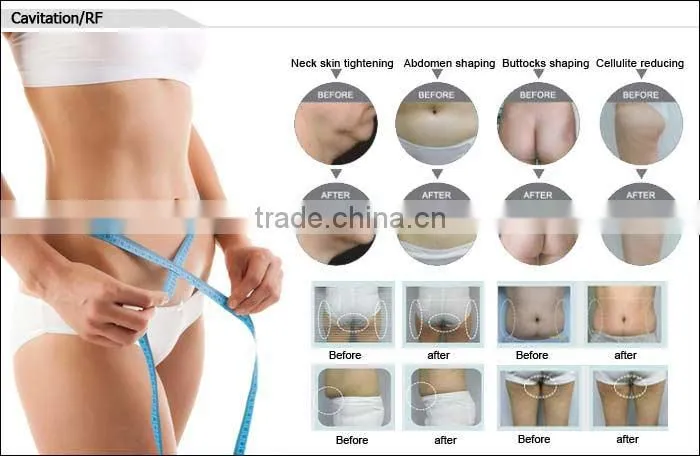 CE approved Portable 5 IN 1 fat splitting system with Cavitation RF