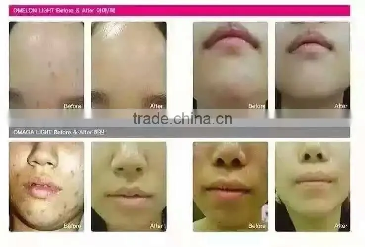 Led Photomodulation Korea Led Light Pdtmachine
