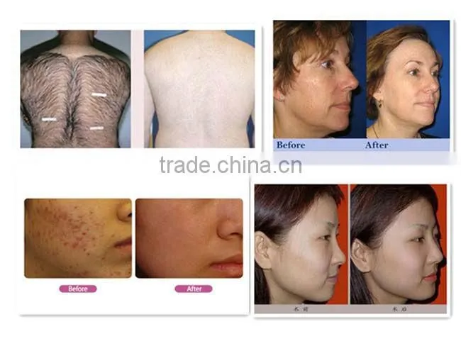 intense pulsed light machine