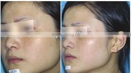 Multi-functional IPL machine for skin rejuvenation/acne removal/hair reomval treatment (FB-AP-TK)