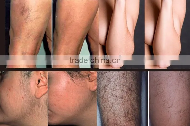 808nm medical diode 808nm laser hair removal laser spare parts