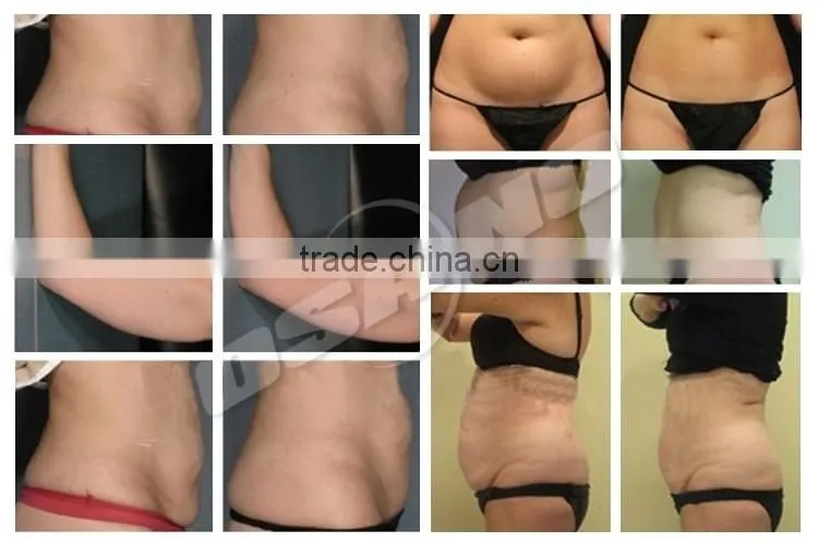 Mini Cryolipolysis For Home Use