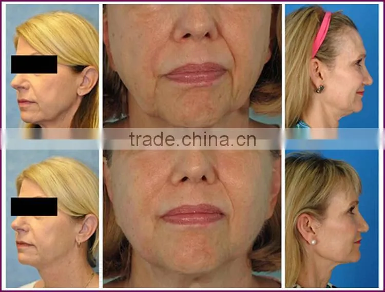 Latest technology hifu korea , face lifting hifu machine