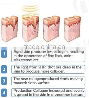 IPL laser hair removal hair removal laser cosmetic machine