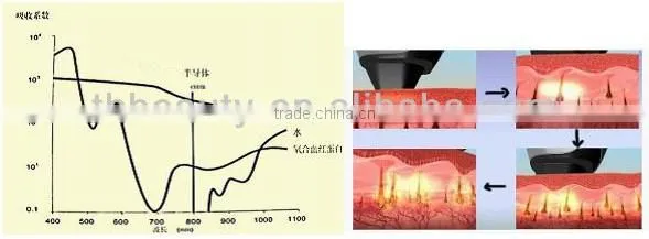 10.000.000 shot full body laser hair removal