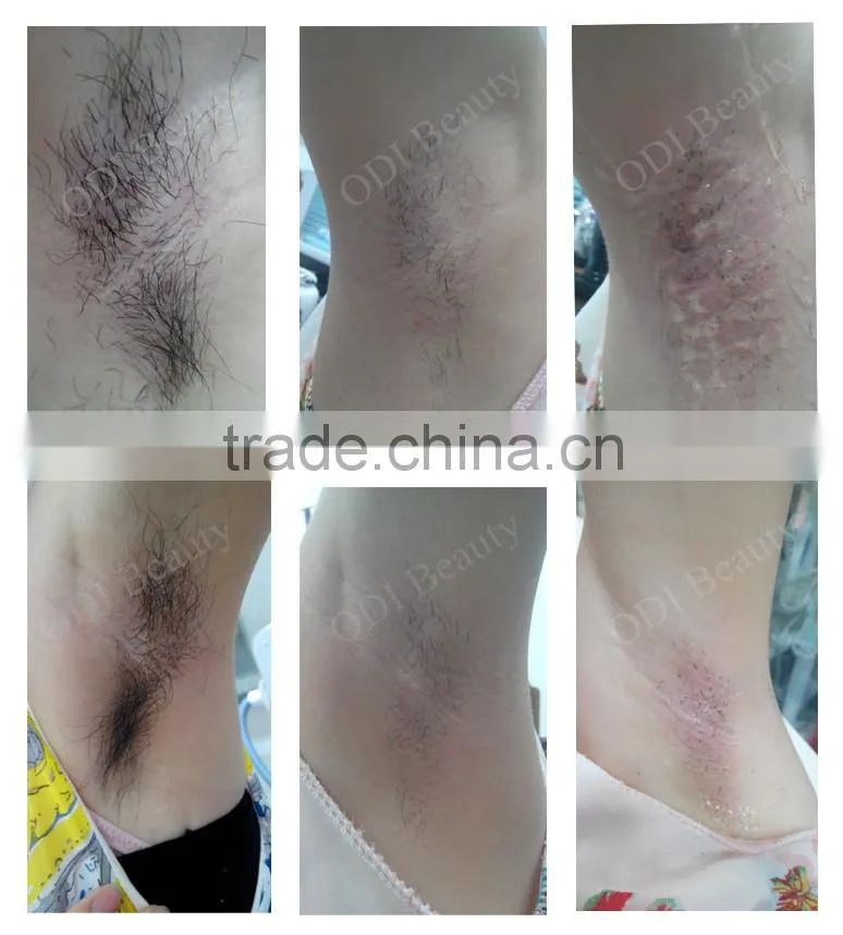 OD-E70 Multifunctional ipl & elight & shr ipl Beauty Treatment Machine(CE certificate)