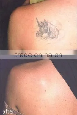 High quality Q-switch nd yag tattoo removal laser for legs women and men with good price D001
