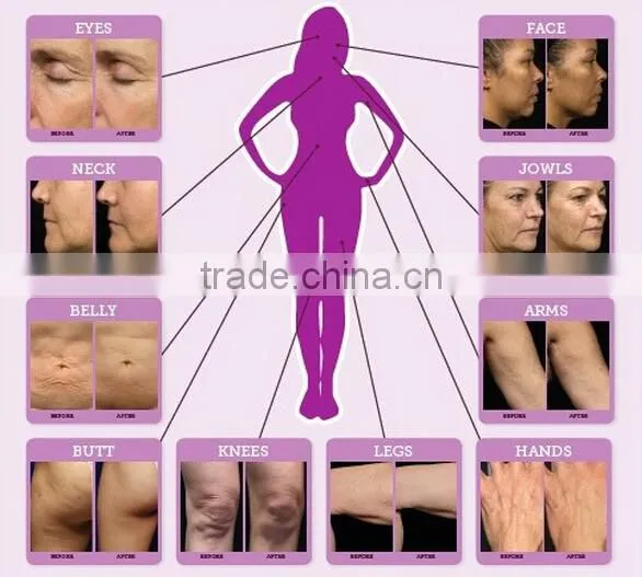 New Hot Invasive Micro Needle Radio Frequency Facial Machine