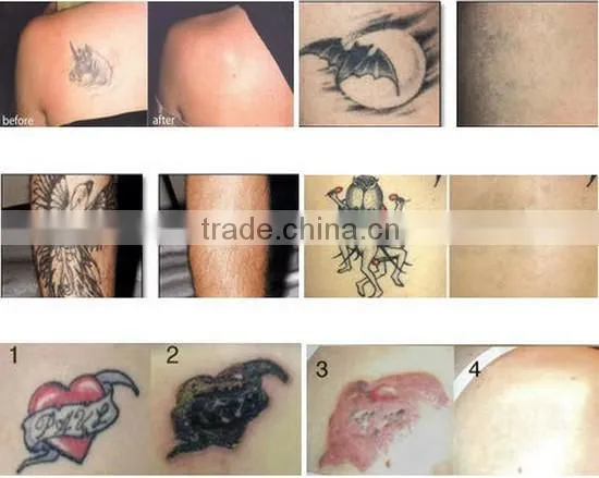 Factory Cheap Laser Remove Tattoo Q Switched Beauty Machine