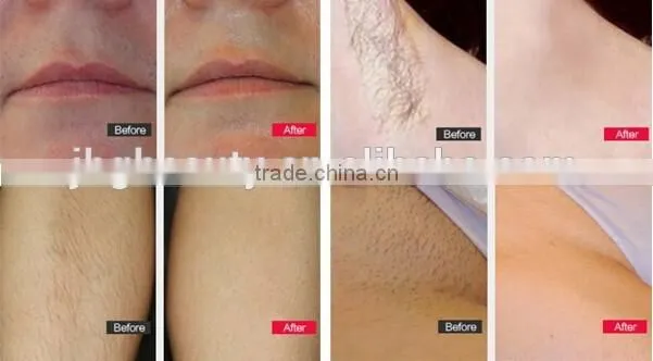 JBG-MINI808 diode laser hair removal machine/808nm diode laser hair removal machine price