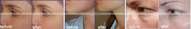 cet&ret body slimming machine monopolar rf