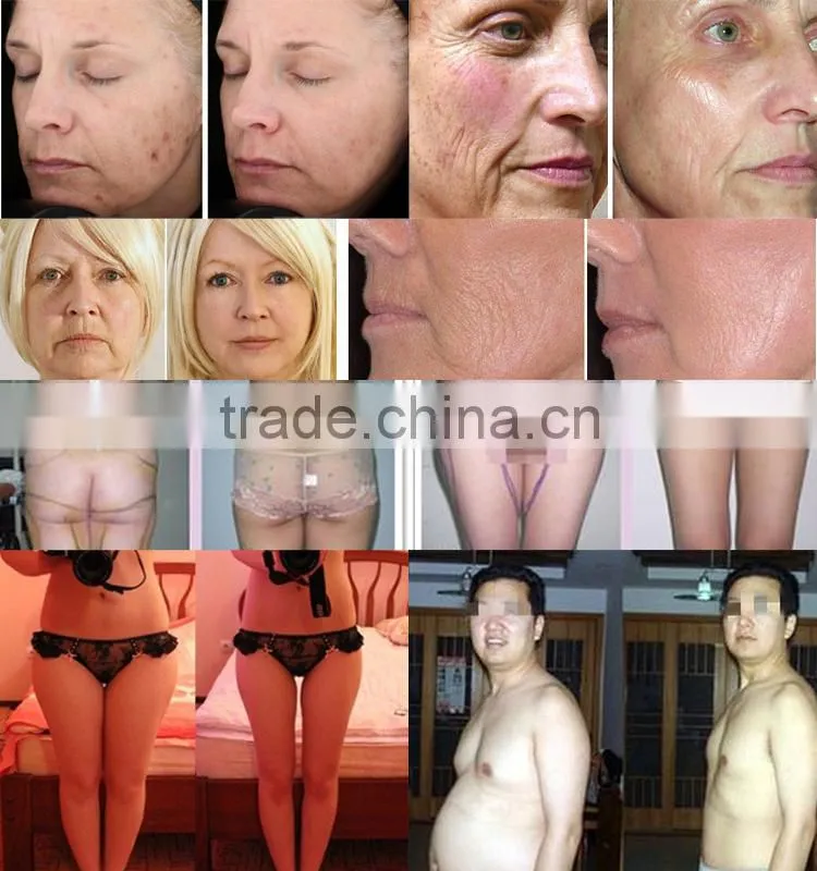 cavitation system ultrasound therapy