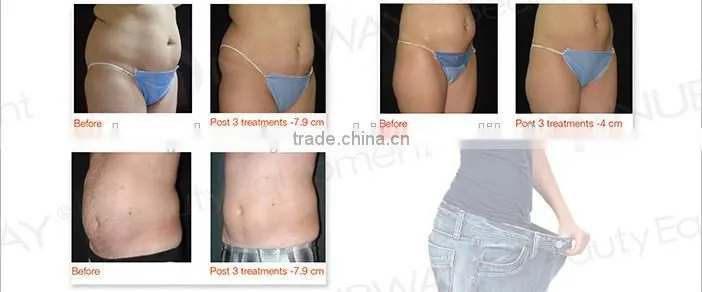 American UltraShape ultrasonic cavitation vacuum slimming machine hifu ultrasound