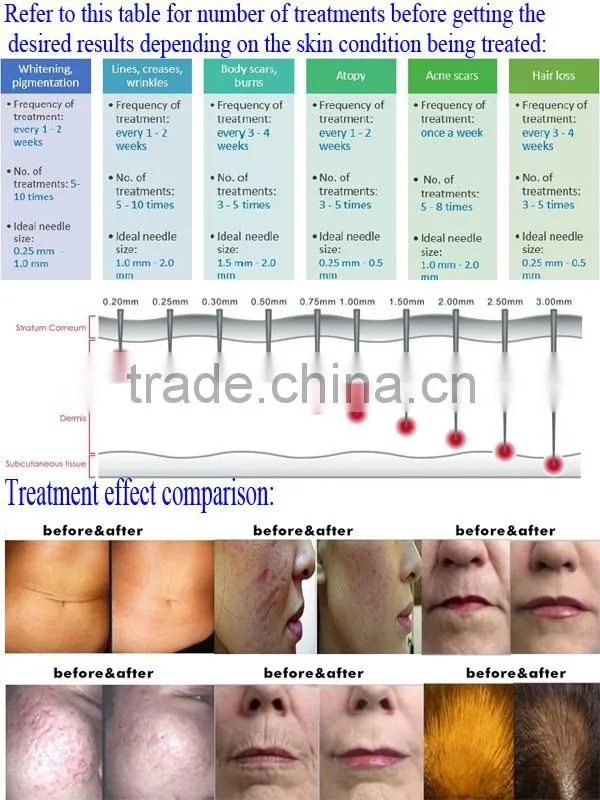 Newest 540 onde comprar dermaroller for hair loss treatment