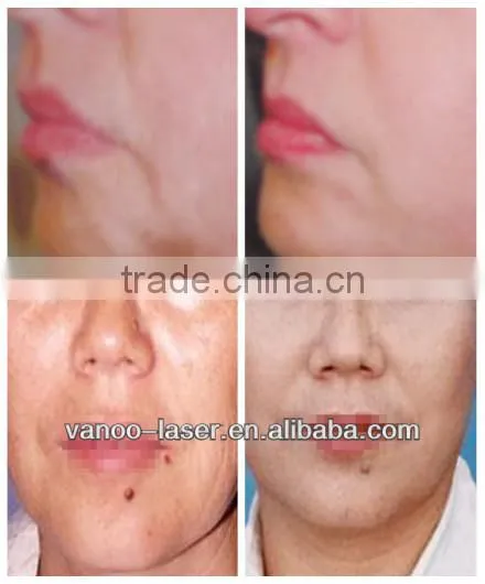 rf high frequency microcurrent galvanic bio face lift machine