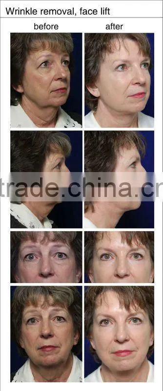 Hair removal permanently electrolysis depilation e-light system