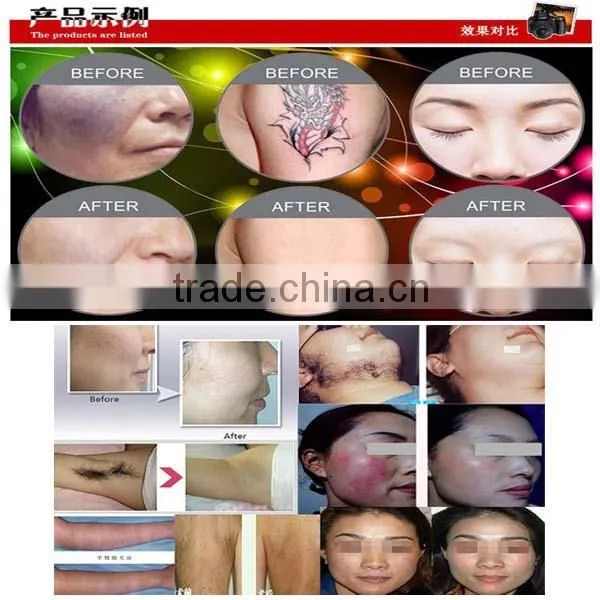 Nd Yag laser ipl saloon beauty machine hand