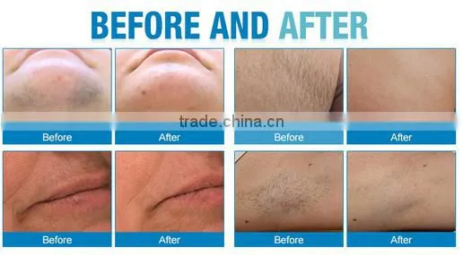 2016 professional Dialysis diode 808nm laser hair removal Machine for Sale